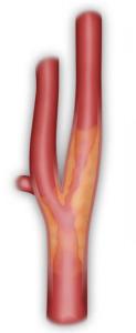 Figure 2 : Sténose Carotidienne