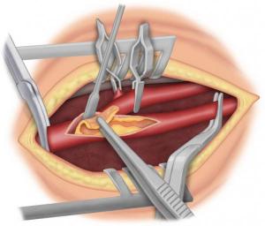 Fig 4 : endartériectomie (retrait de la plaque)