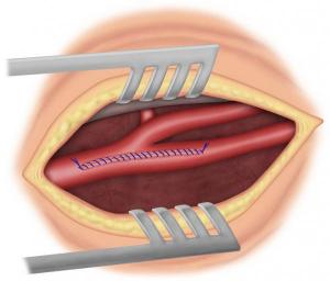 Fig 5 : Suture directe