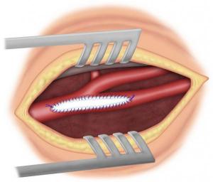 Figure 7 : Patch carotidien