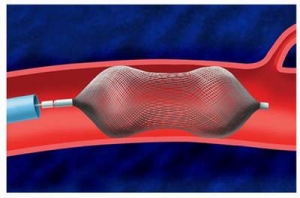 Can thiệp tim mạch chữa bệnh tim bẩm sinh